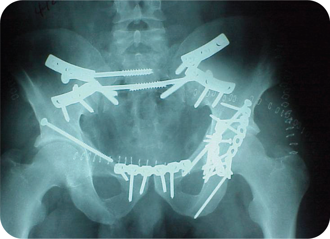 pelvic x-ray