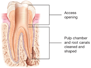 root canal opening