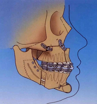 Sideview of plates and screws used during orthognathic surgery.