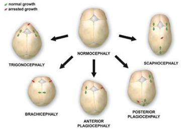 Shows forms of craniosynostosis. See figure caption for details.