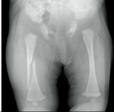 x-ray of pelvis of a baby