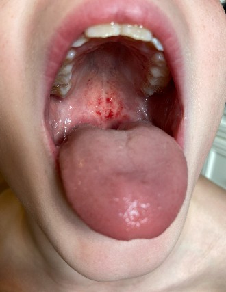 Bloody sore throat of a young boy